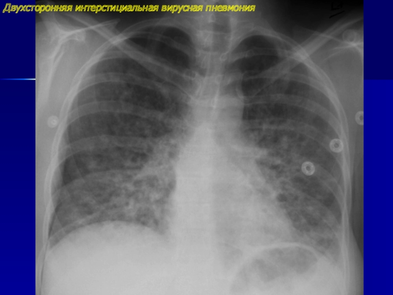 Рентген картина пневмонии