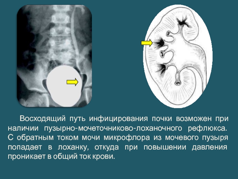 Члс почек