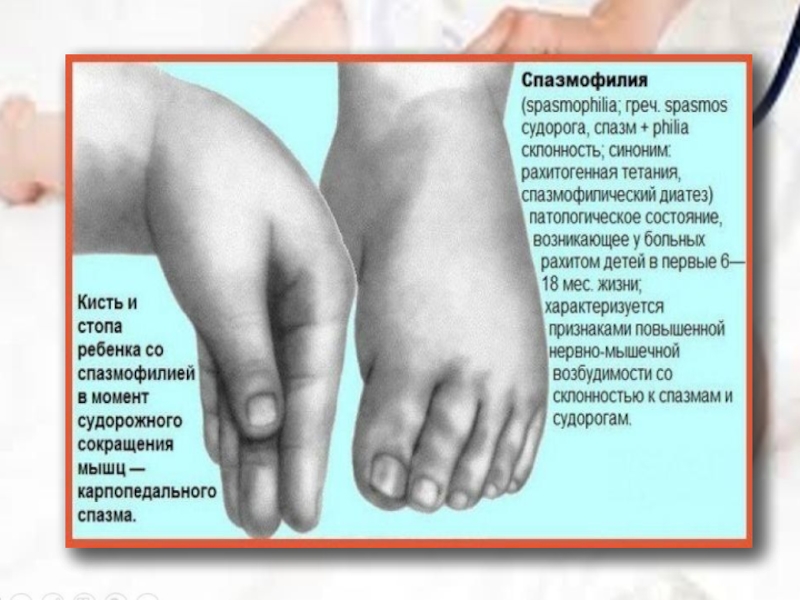 Руки и ноги коликами. Судороги при спазмофилии у детей. Характерный признак спазмофилии у детей. Спазмофилия причины судорог у детей. Судорожный симптом у детей.