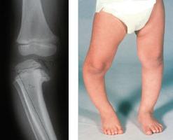 the symptoms of rickets in infants