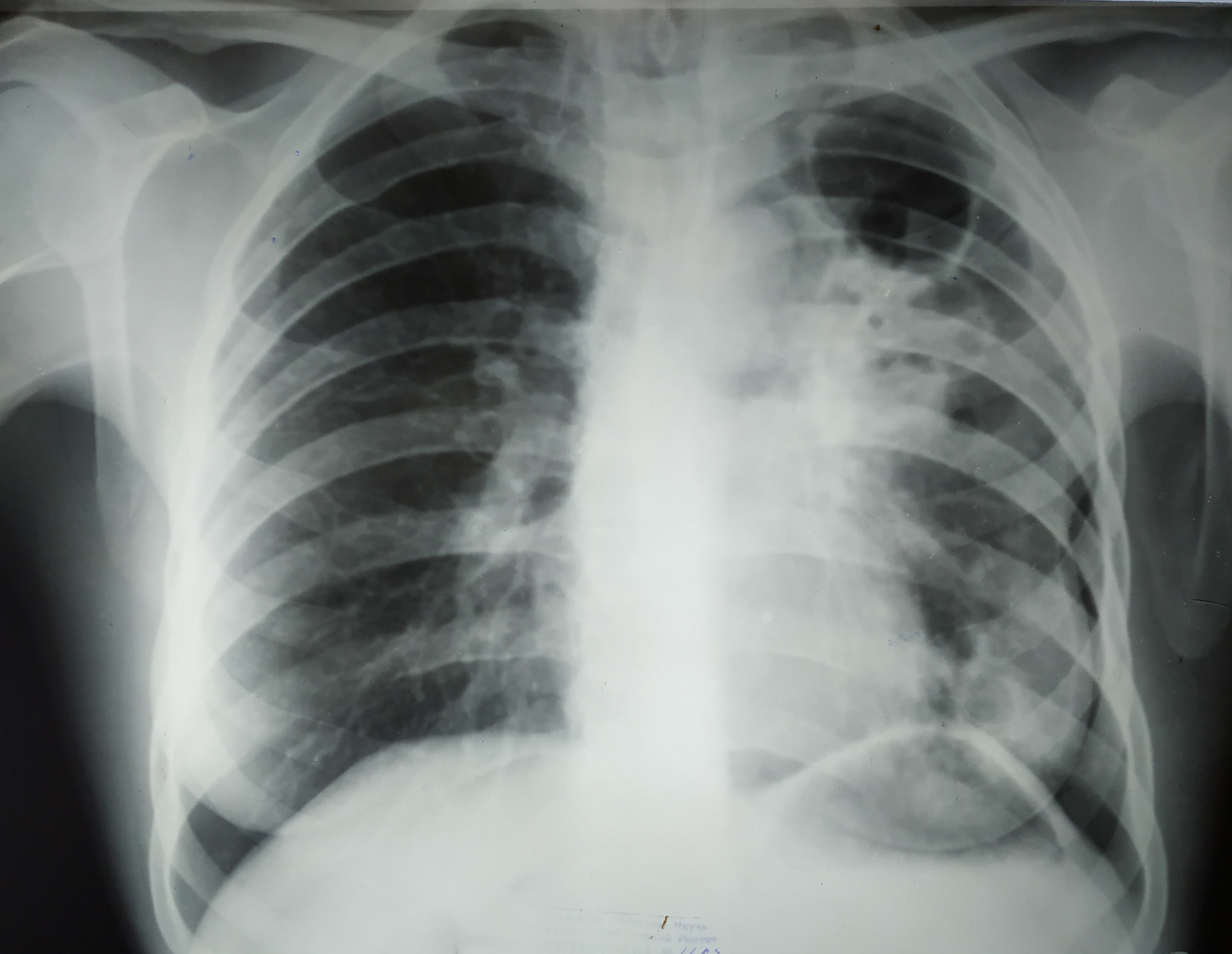 Рентген снимок фиброзно кавернозный туберкулез