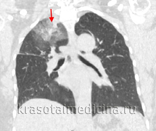 КТ органов грудной клетки. Инфильтрация верхней доли правого легкого у пациента с верифицированным туберкулезом