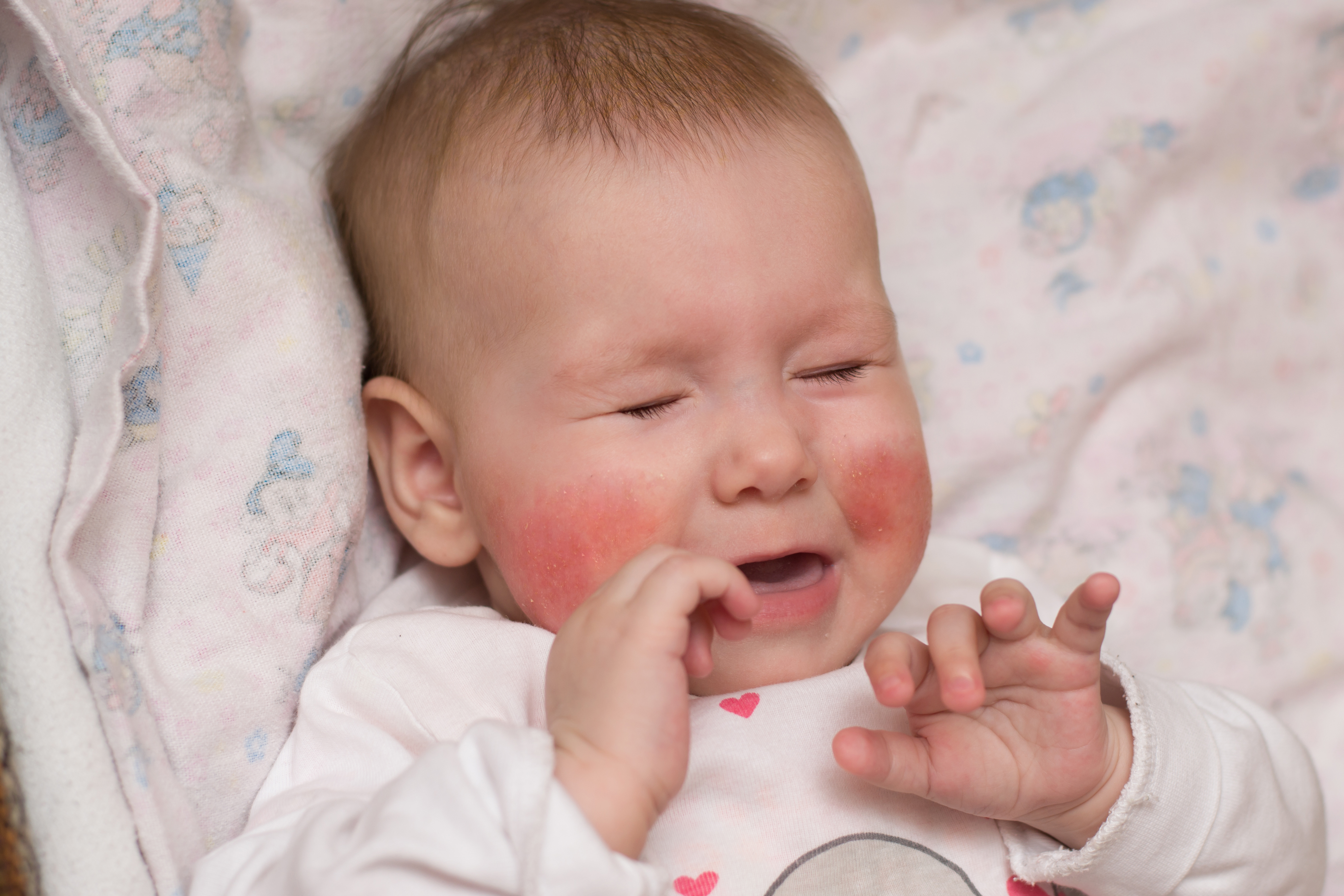 У ребенка горят щеки. Лимфатико-гипопластический диатез у детей. Лифатико гипопластичдиатезы у детей.