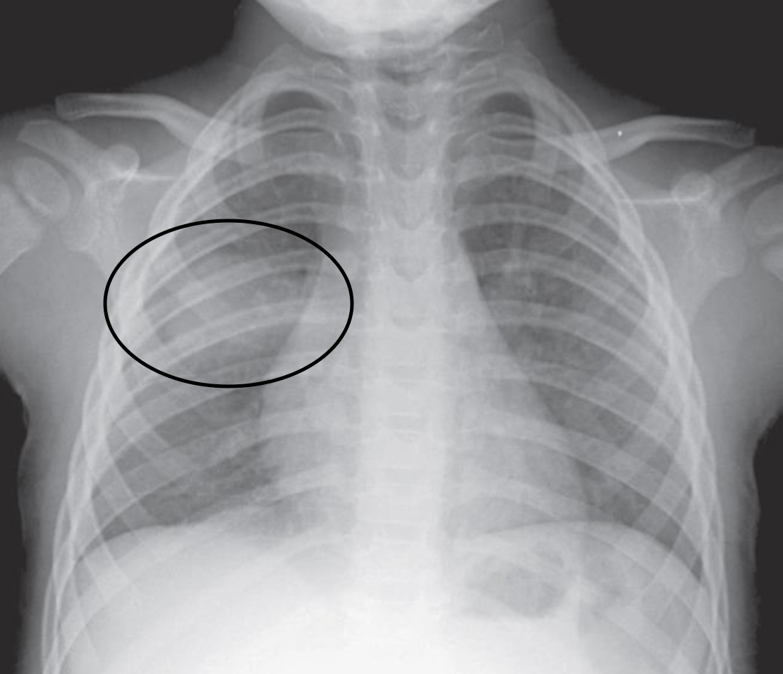 Воспаление легких на снимке рентгена фото
