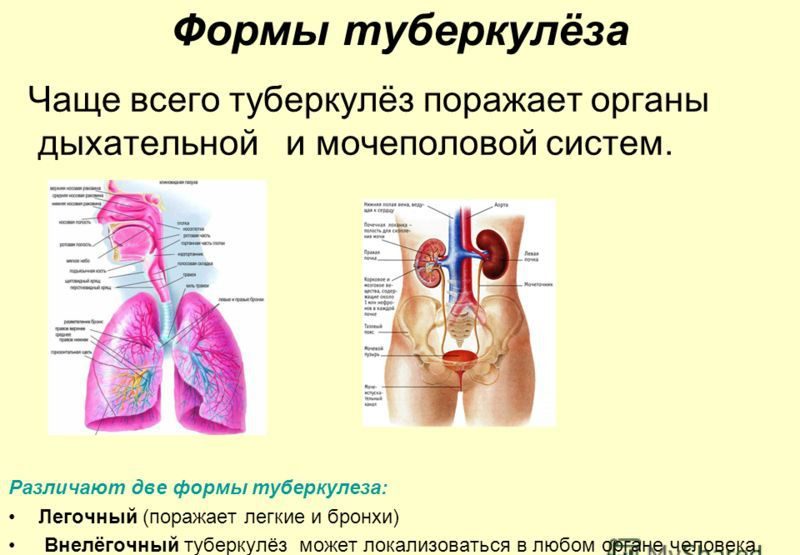 различия туберкулеза у человека