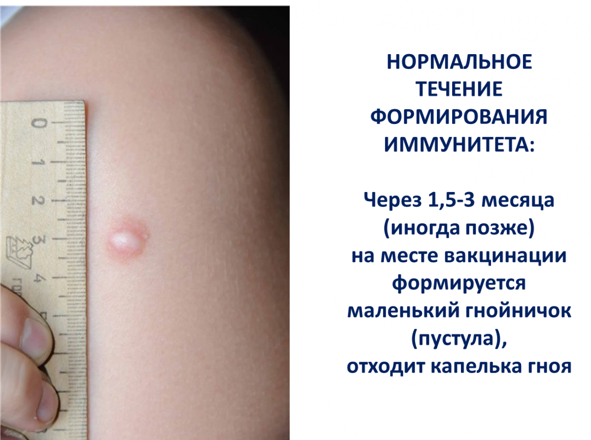 После прививки ставить манту. Прививка БЦЖ норма реакции. БЦЖ прививка в 2 месяца норма. БЦЖ прививка реакция ребенка 2 года.