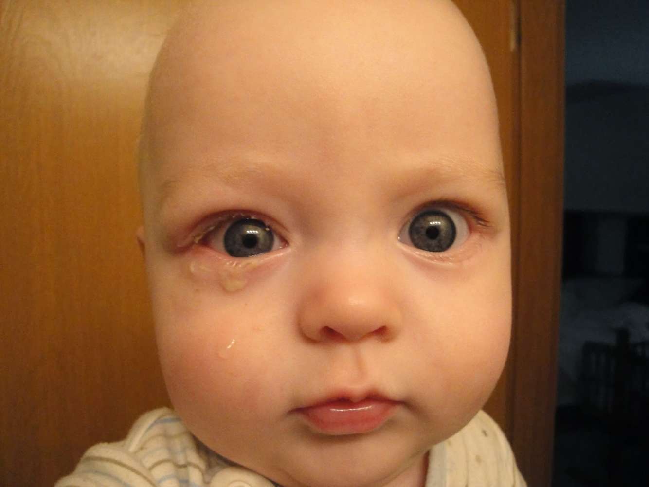 Коньюктивит у ребенка 6 лет. Конъюнктивит у новорожденных. Конъюнктивит у детей новорожденных. Глаза ребенка.