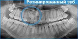 Рентген ретинированного зуба